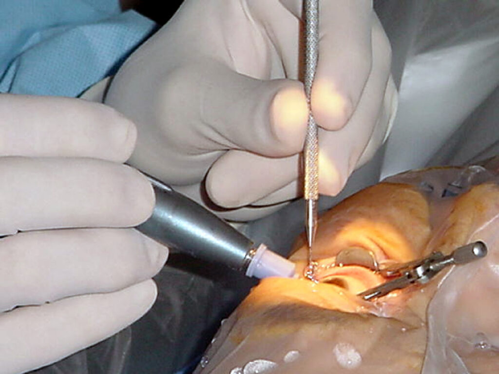 Cataract Surgery