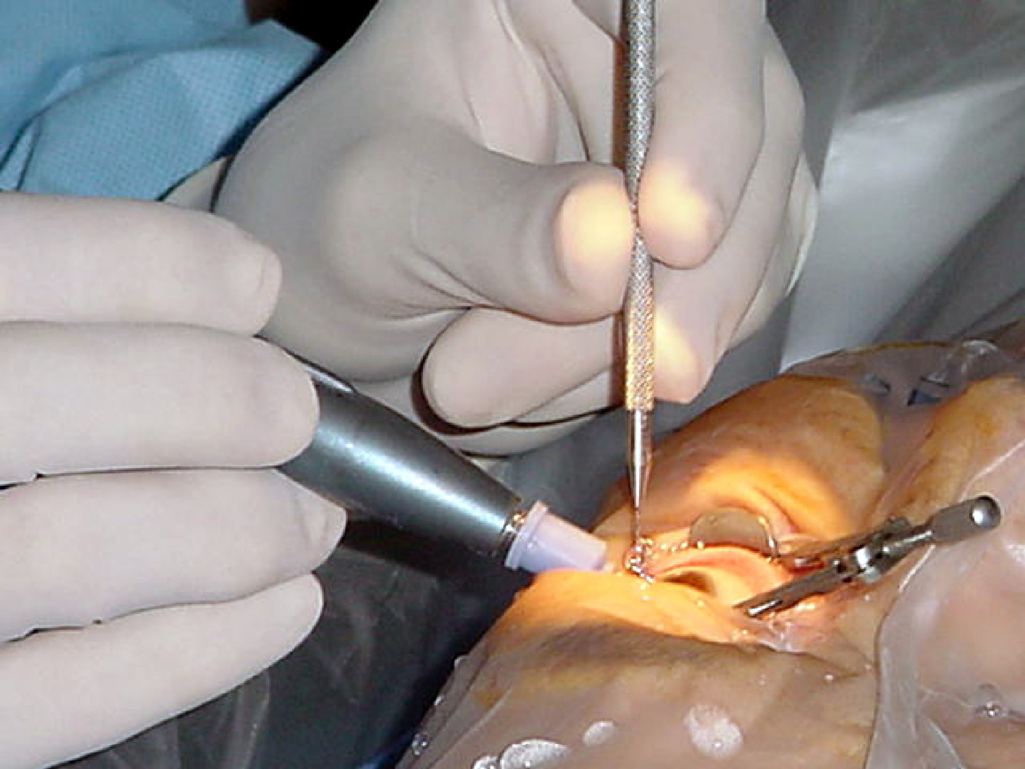 Read more about the article When is the Right Time for Eye Cataract Surgery?