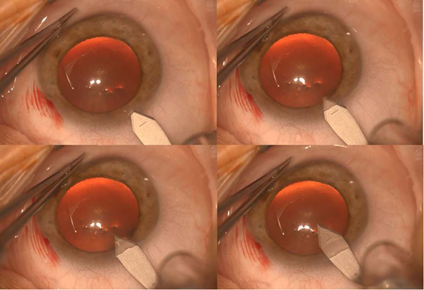 Read more about the article Cataract Surgery Cost: What to Expect in Australia
